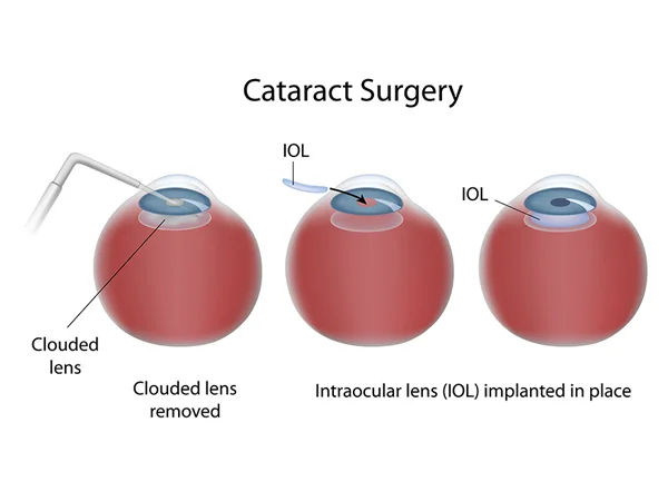 Cataract Lens