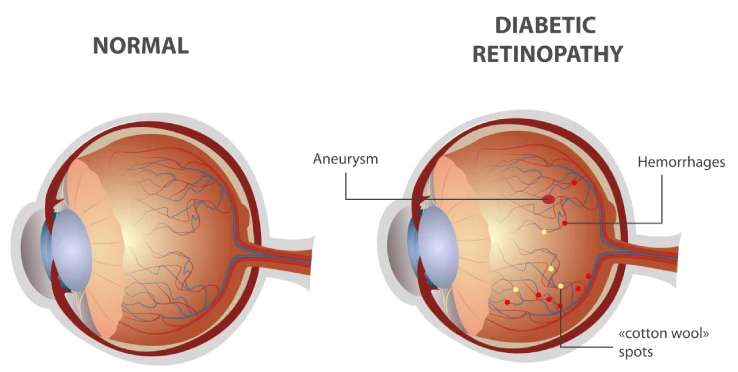 Diabetic Retinopathy