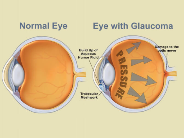 Eye With Glaucoma