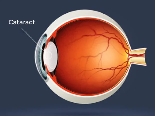 Intraocular lenses (IOLs) Cataract
