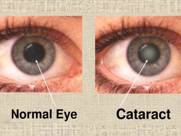 Normal Eye vs Cataract