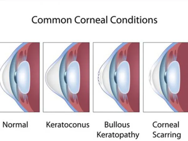Common Corneal Conditions
