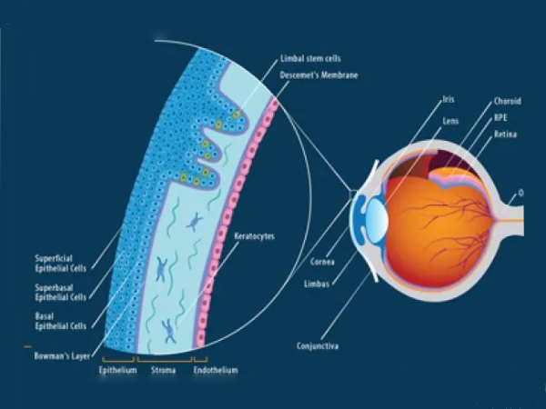 Cornea Treatment