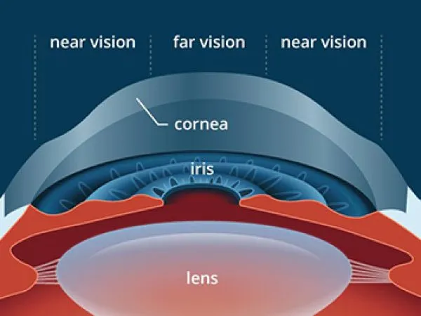 Laser Vision Correction