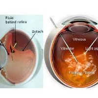 Age Related Macular Degeneration