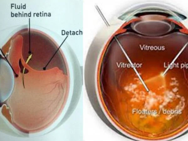 Vitreoretina