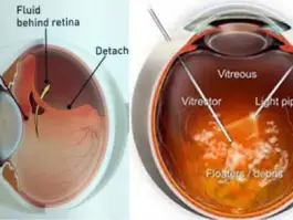 Retina Treatment