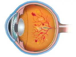 Retina Treatment