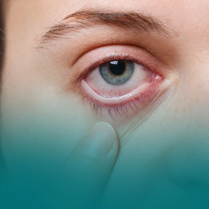 Ocular Inflammation Treatment Uvea Clinic in Trinity Eye Hospitals